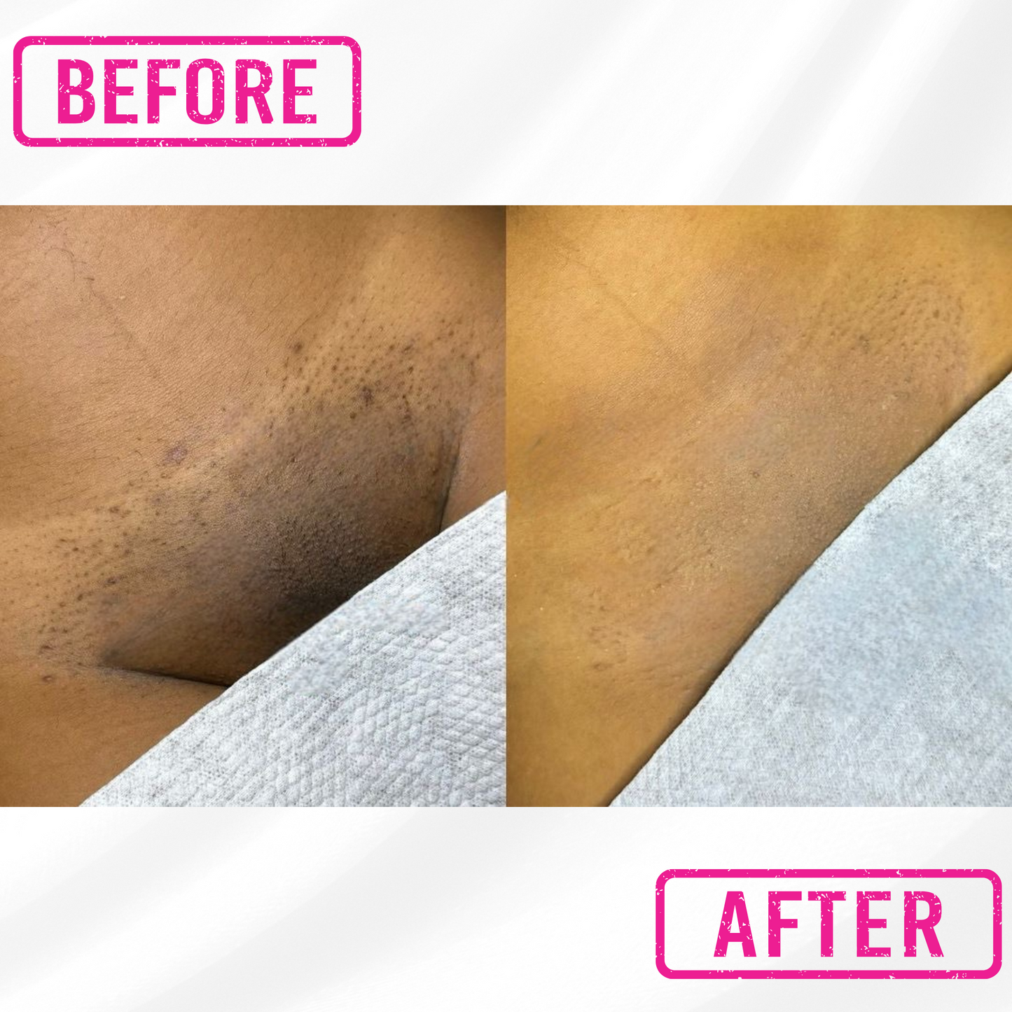 B Smooth & Bright Ingrown Hair Relief + Skin Brightening Solution